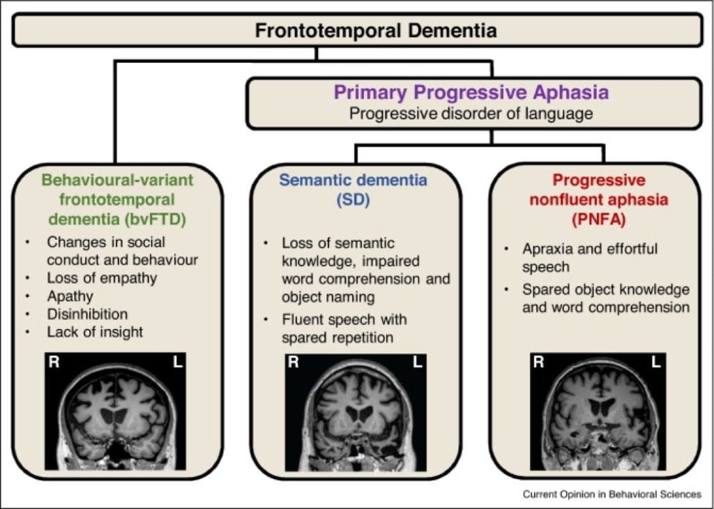 FRONTO-TEMPORAL DEMENTIAS
