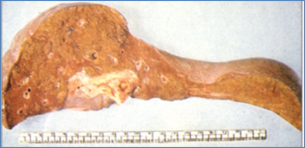 FULMINANT liver FAILURE