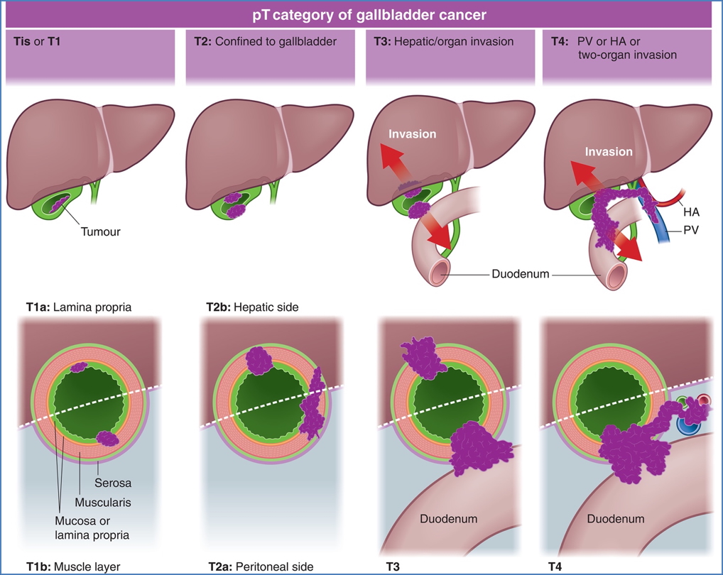 biliary cancers - GALLBLADDER CARCINOMA