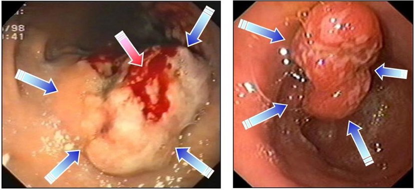 GASTRIC & DUODENAL CANCERS