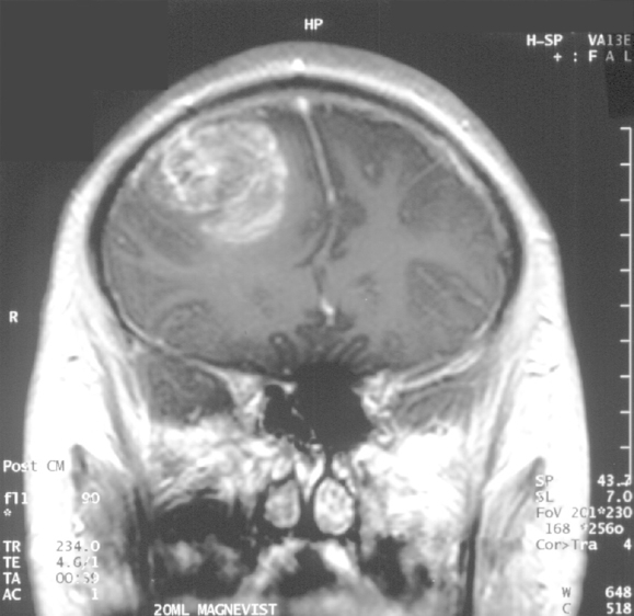 Glioblastoma Multiforme