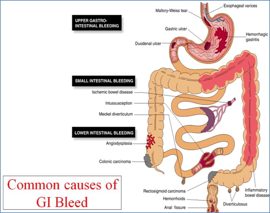 GI BLEEDING