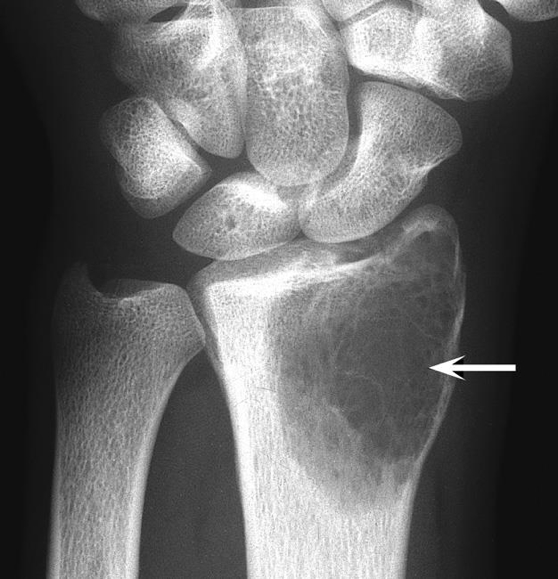 malignant bony tumours - GIANT CELL TUMOUR OF THE BONE