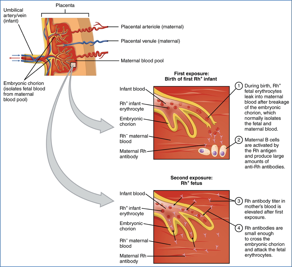 HAEMOLYTIC DISEASE OF THE NEWBORN