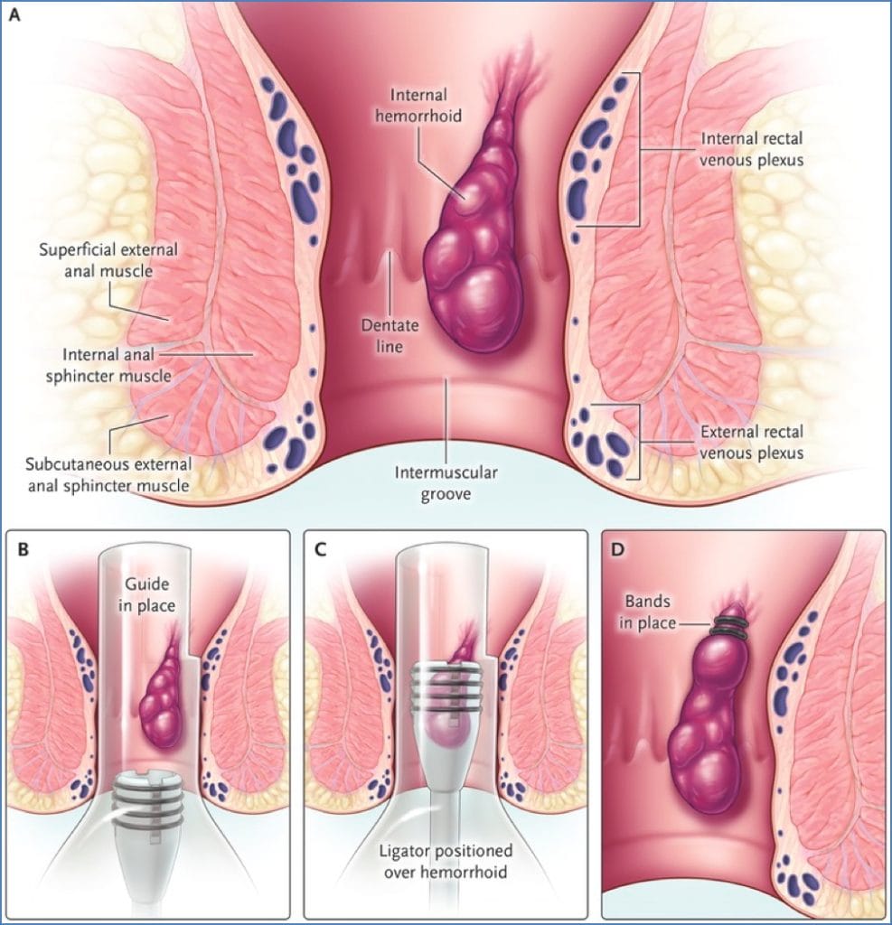HAEMORRHOIDS treatment