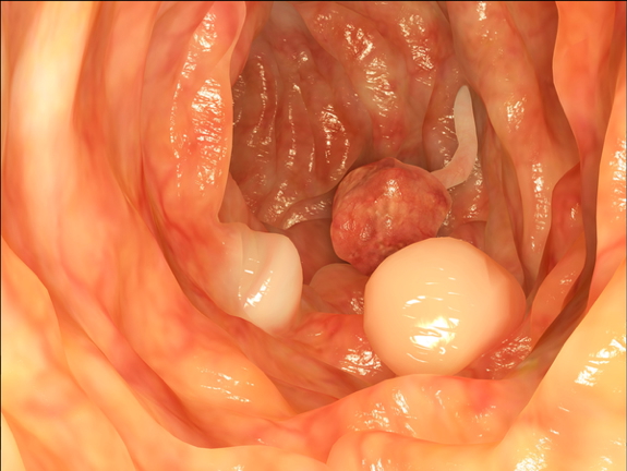 polyps & colon cancer - HAMARTOMATOUS
