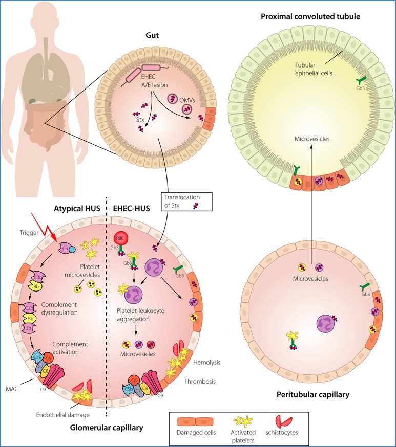 HEMOLYTIC-UREMIC SYNDROME