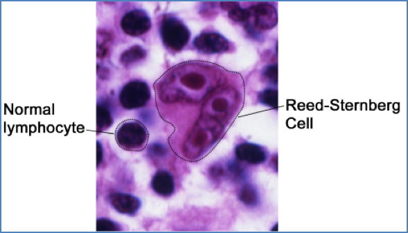 HODGKIN’S LYMPHOMA