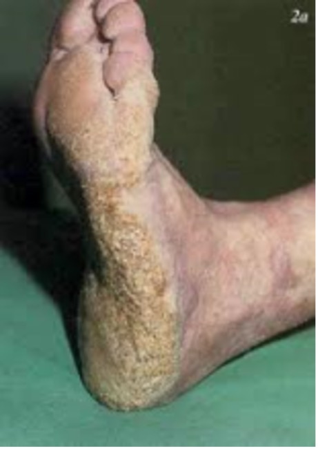 Dermatology Basics - Hyperkeratosis