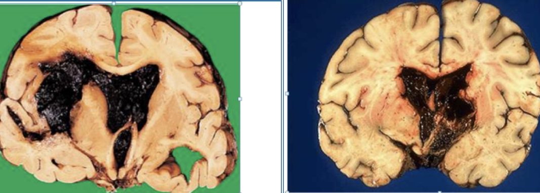 cerebrovascular accidents - INTRACEREBRAL HAEMORRHAGE 