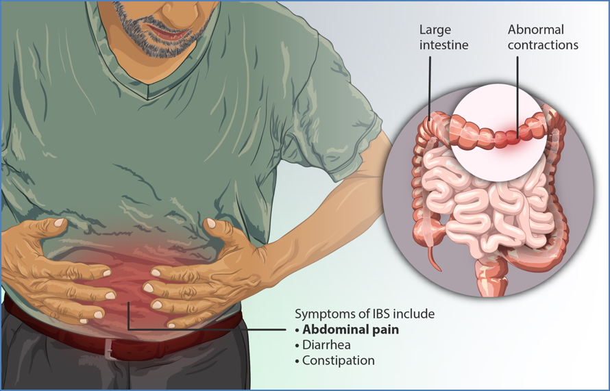 IRRITABLE BOWEL SYNDROME