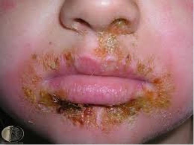Dermatology Basics - Impetiginised Impetigo