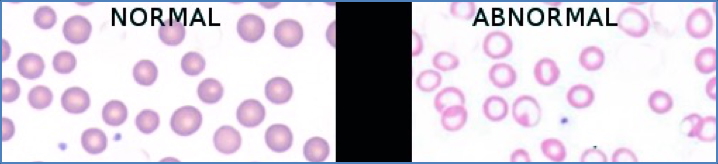 Iron Deficiency Anaemia