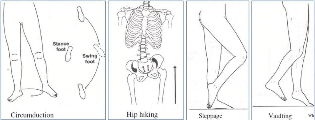 Leg length discrepancy
