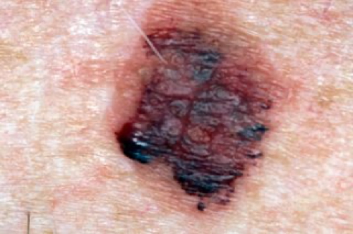 MALIGNANT MELANOMA