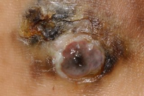 Acral Lentiginous Melanoma