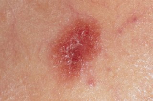 Amelanotic Melanoma