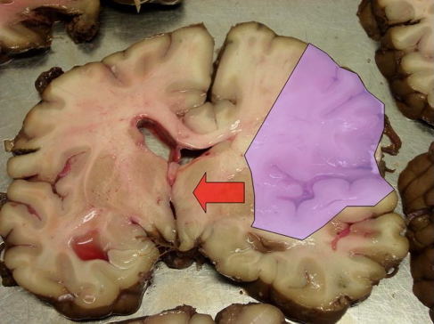 cerebrovascular accidents - MCA stroke