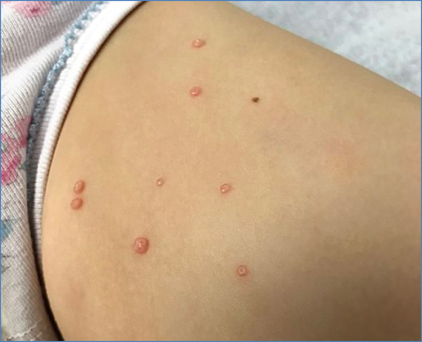 MOLLUSCUM CONTAGIOSUM