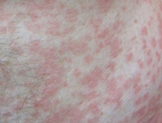 MORBILLIFORM DRUG Eruptions