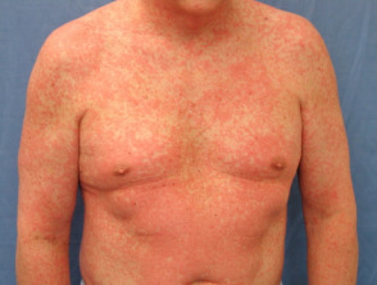 MORBILLIFORM DRUG Eruptions