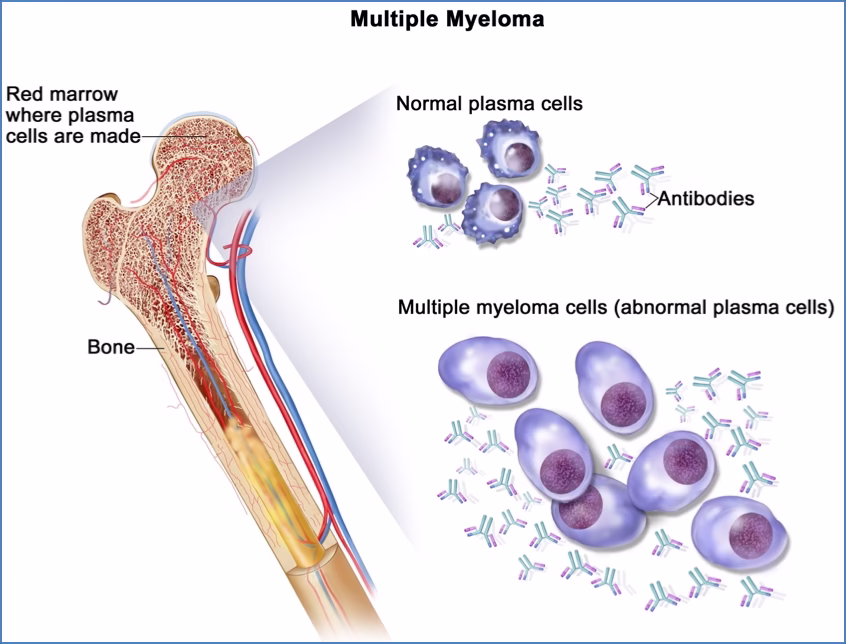 MULTIPLE MYELOMA