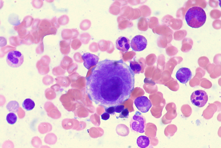 MYELODYSPLASTIC Syndromes