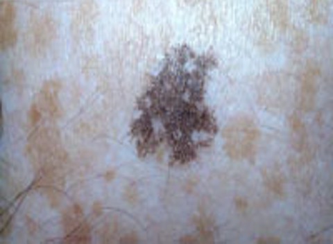 Dermatology Basics - Macule