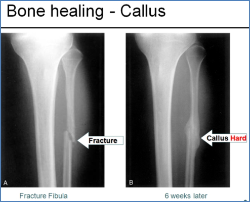 bony injuries - Mechanisms of Fracture Healing