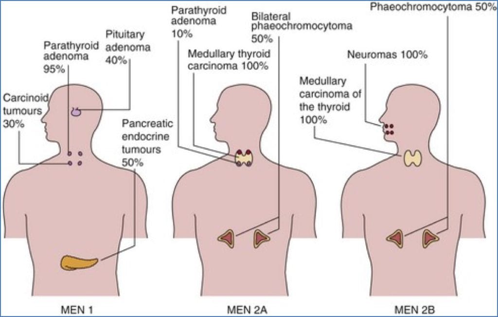 Pancreatic endocrine tumours - Multiple Endocrine Neoplasia