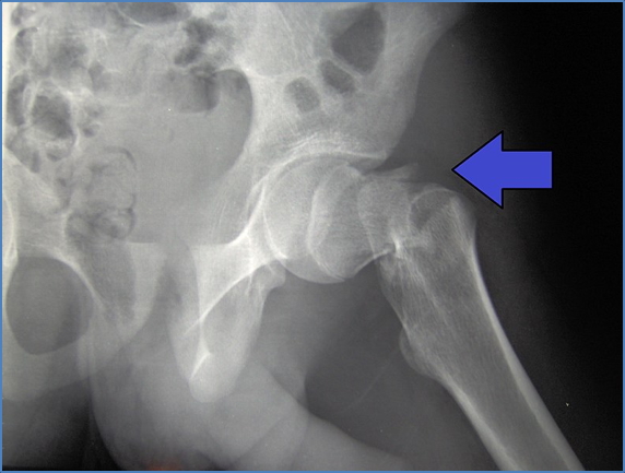 Neck of Femur Fracture