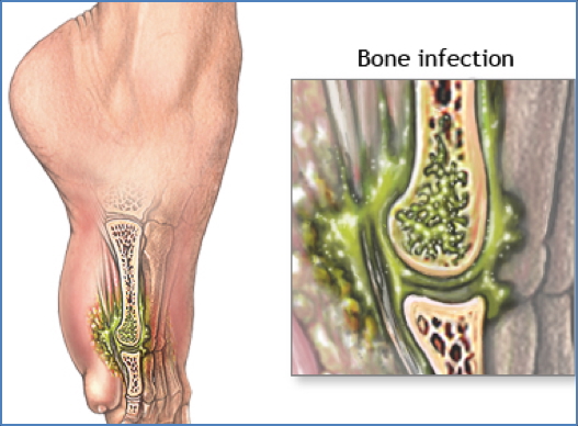 OSTEOMYELITIS