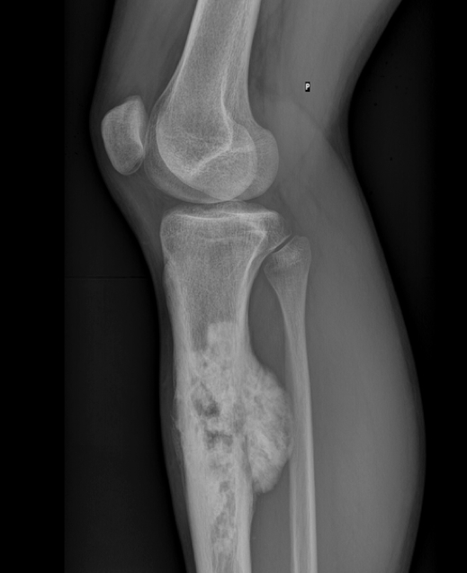 OSTEOSARCOMA