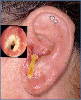 ear infections - OTITIS EXTERNA