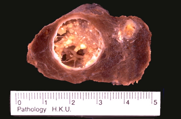 PAPILLARY CARCINOMA