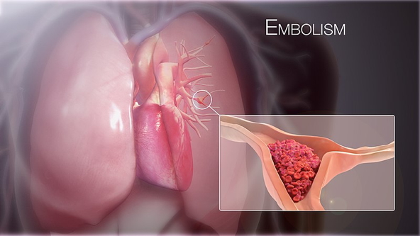 thrombotic disorders - pulmonary embolus