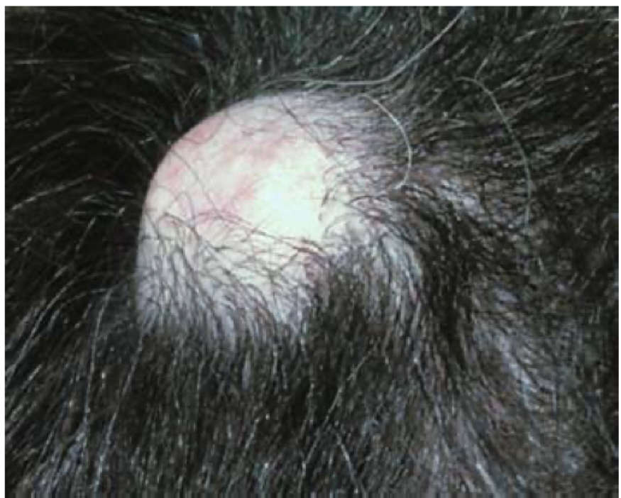 benign skin cysts - PILAR CYST