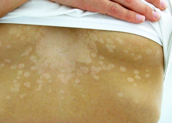 PITYRIASIS (TINEA) VERSICOLOR