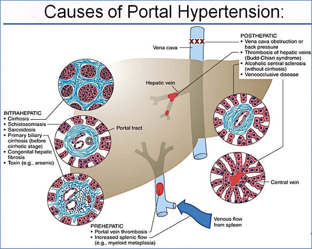 PORTAL HYPERTENSION