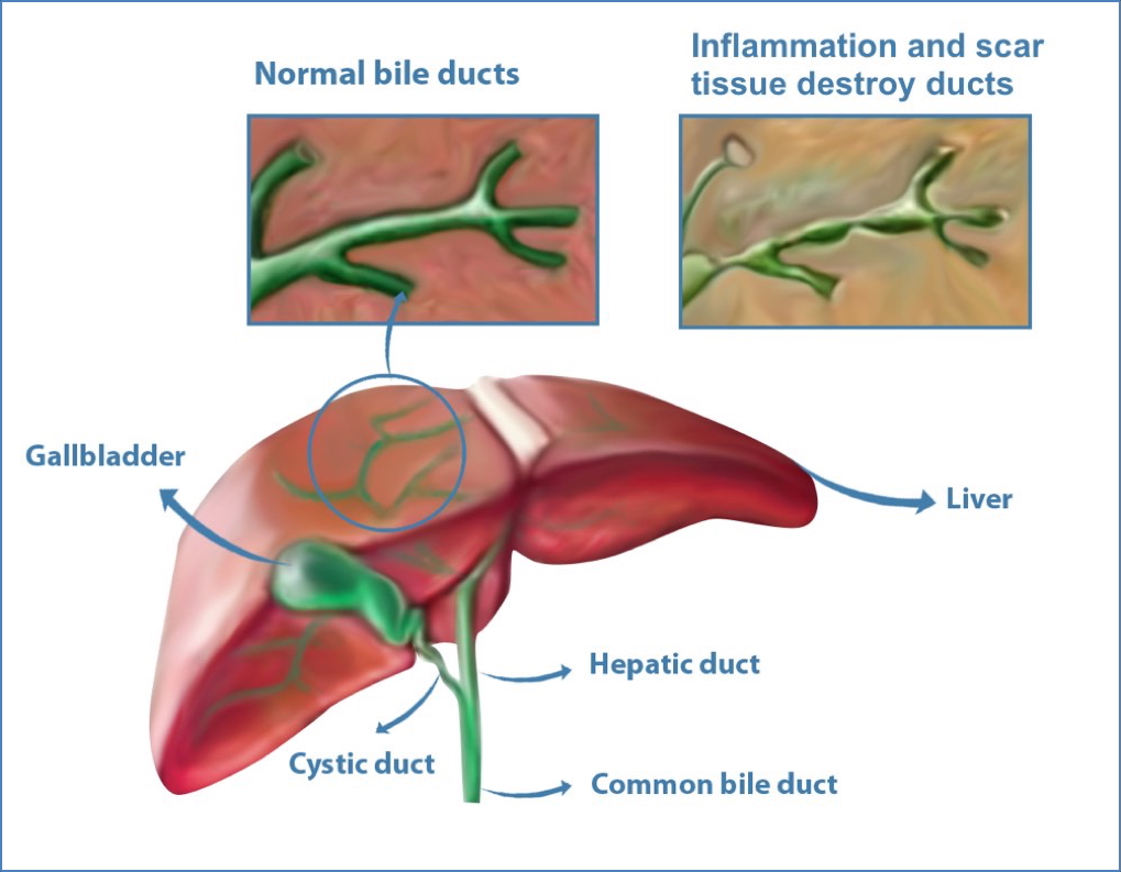 PRIMARY BILIARY SCLEROSIS