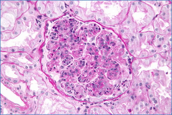 PSGN – POST-STREP GLOMERULONEPHRITIS