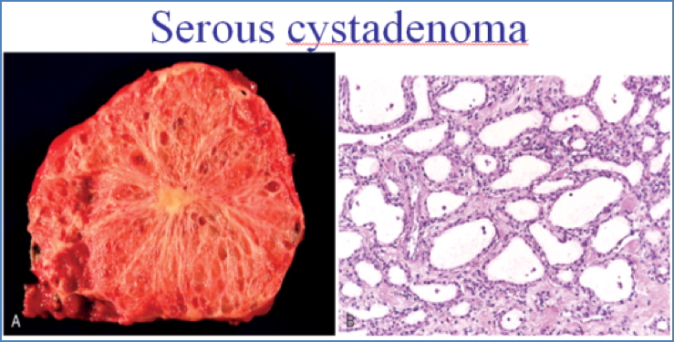 Pancreatic Cysts