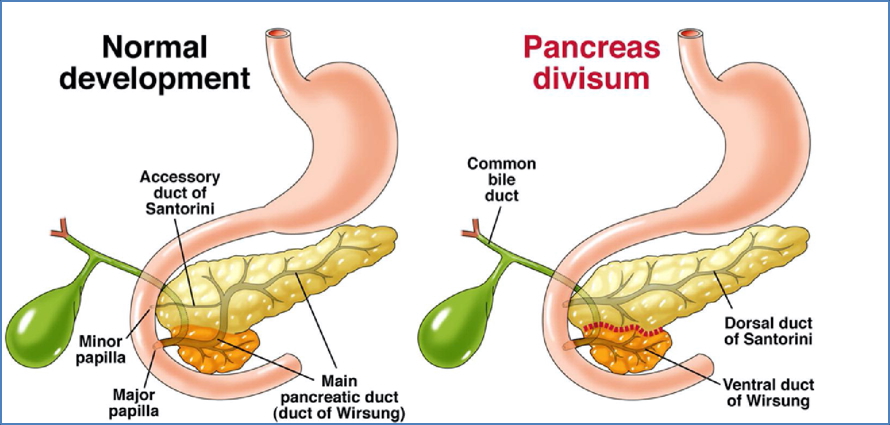 congenital pancreatic abnormalities - Pancreatic Divisum