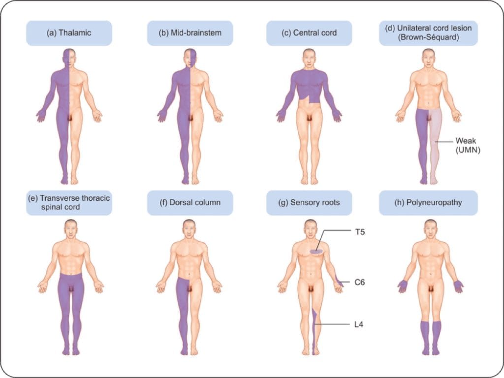 neurological Patterns of Loss of Sensation