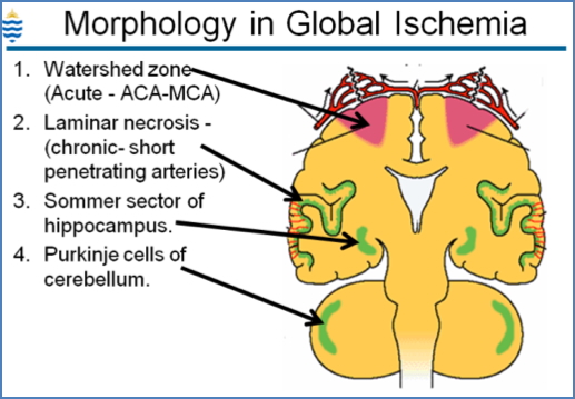 Ischaemic Encephalopathy watershed zones