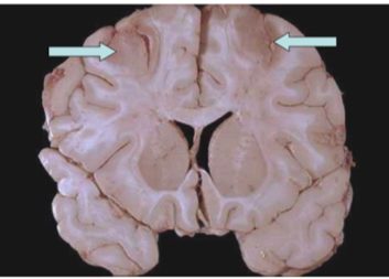 Watershed boundary zone infarcts