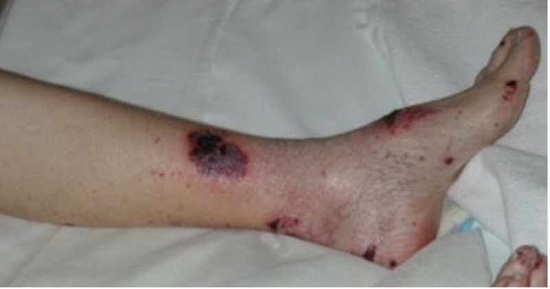 Dermatology Basics - Purpura