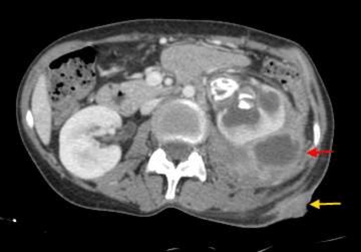 RENAL AND PERINEPHRIC ABSCESS