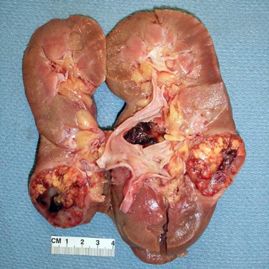 RENAL CELL CARCINOMA