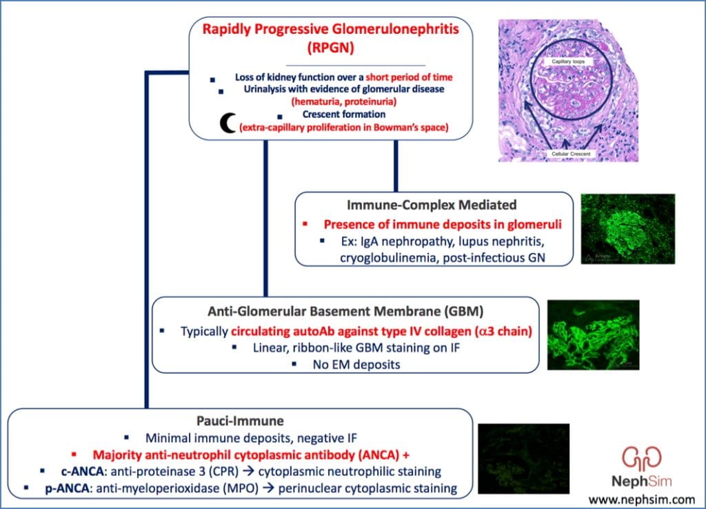 Crescentic Rpgn Rapidly Progressive Glomerulonephritis | Renal | MedStudentNotes